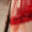 9-летний мальчик до кости распорол ногу на детской площадке в Воронеже - ГТРК Воронеж