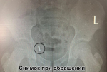 У воронежского школьника из аппендикса достали магнитики