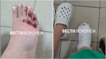 Жительница Воронежа получила перелом ноги после наезда велосипедиста