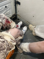 Стая бешеных собак набросилась на девушек в воронежском ЖК – им прокусили ноги